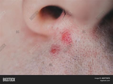 Pimple Under Nose Image And Photo Free Trial Bigstock