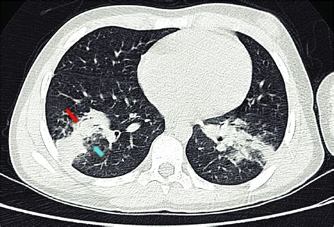 Lung View Of Chest Ct Scan From Case 1 Showing Ground Glass Opacity