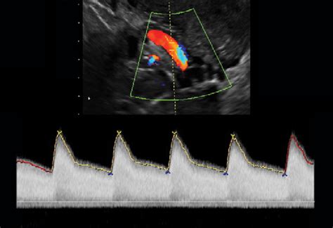 Transvaginal Ultrasound Showing The Uterine Artery Doppler The Uterine