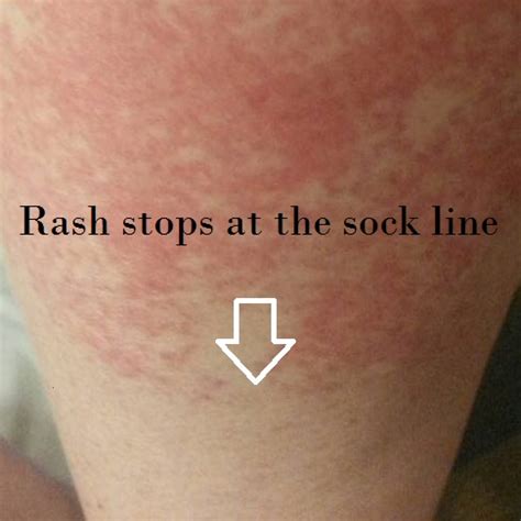 Red Rash On Lower Legs Pictures Photos