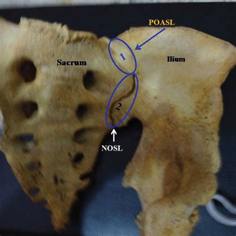 Pdf Ossification Of Anterior Sacroiliac Ligament And Its Clinical