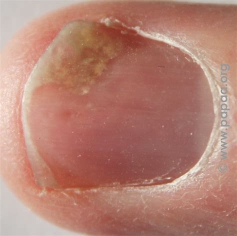 What Are The Most Common Changes That Occur With Nail Psoriasis