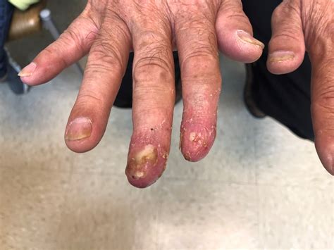 Painful Recurrent Rash On The Fingers Clinical Advisor