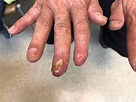 Painful, Recurrent Rash on the Fingers - Clinical Advisor