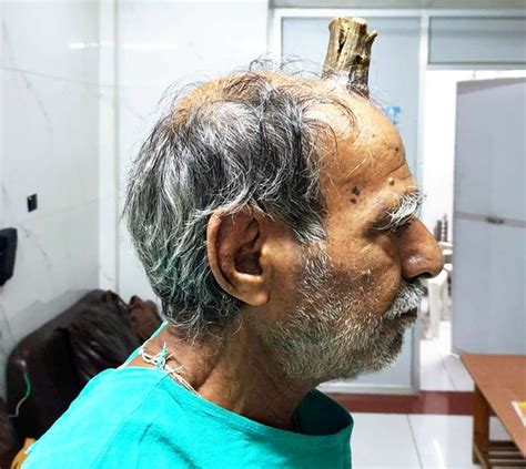 Four Inch Devil Horn That Grew After Man Banged His Head Is