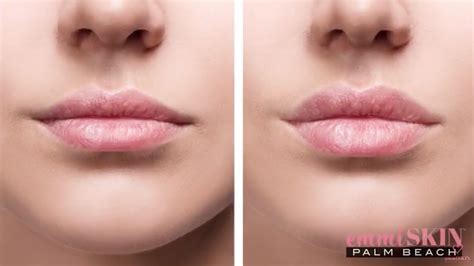 How To Get Fuller Lips Fast Without Injections Youtube