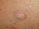 Actinic Keratosis (Solar Keratosis, Sun Spots) - Dermatology Advisor