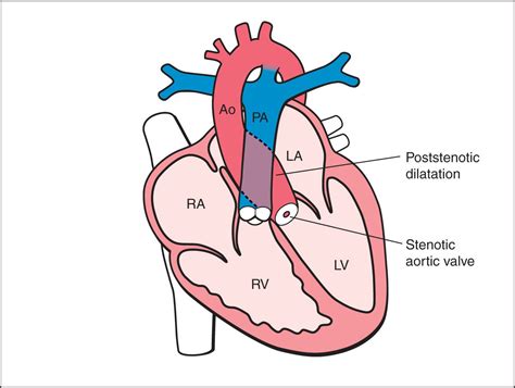 Aortic Stenosis Diagram