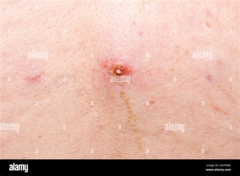 Infected Sebaceous Cyst Centre On The Back Of A 47 Year Old Man