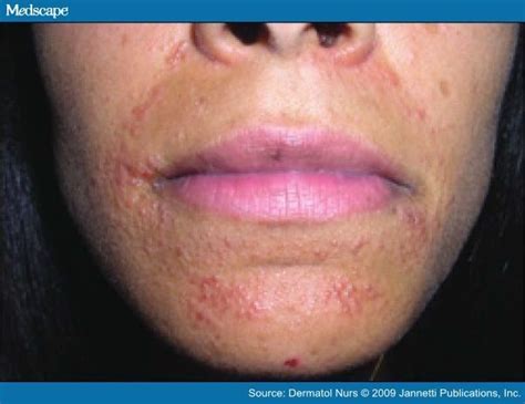 Periorbital Dermatitis Its Not Every Rash That Occurs Around The Mouth