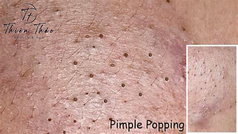 Pimple Popping Squeeze Acne Pustules With Thien Thao Spa 008 Youtube
