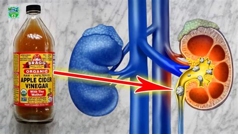 How To Use Apple Cider Vinegar To Dissolve Kidney Stones Youtube