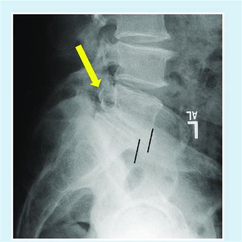 Radiograph Of Fracture Of Pars Interarticularis Yellow Arrow With