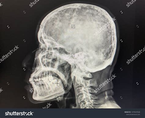 Osteolytic Lesion Skull Lateral View Multiple Stock Photo 1479547028