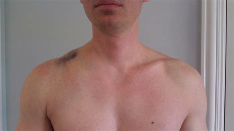 Related Keywords And Suggestions For Swollen Clavicle