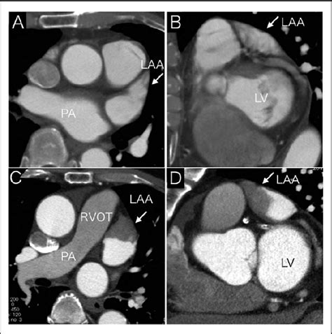 Cardiac Computed Tomography Cct Of The Left Atrial Appendage Laa