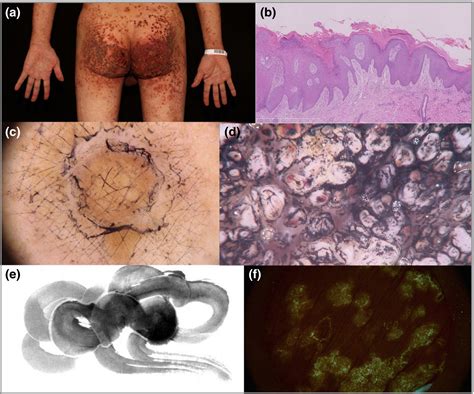 Image Gallery Porokeratosis Under The Dermoscopic Furrow Ink Test And