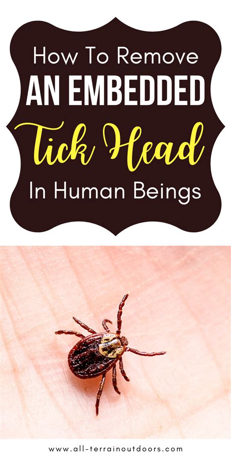 How To Remove A Tick Head Stuck In Skin 2021