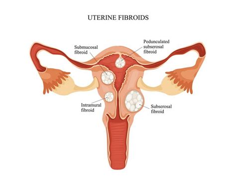 Vaginal Pain Causes Treatments Prevention Anatomy