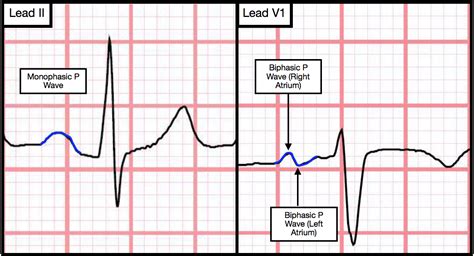 P Wave Is Usually Biphasic Cardiology Outlines