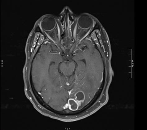 Case Of Mistaken Identity Cerebral Cryptococcoma In An Immunocompetent