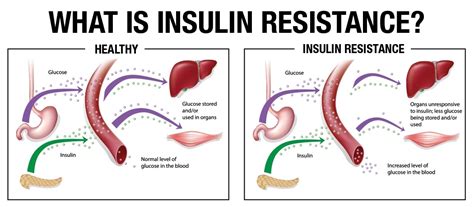 Resistencia A La Insulina Y Mortalidad Por Cáncer Y Por Todas Las
