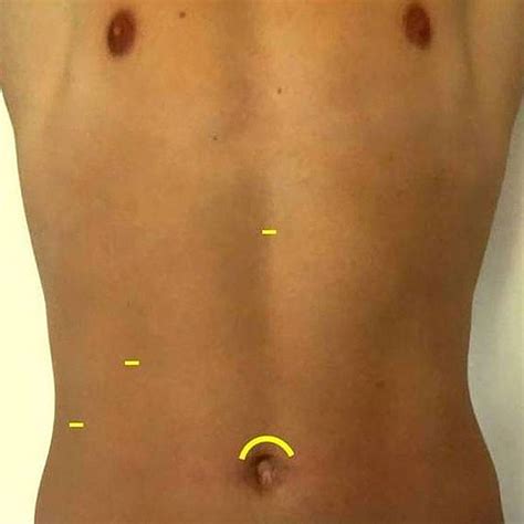 Die gallenblase wird unter sichtkontrolle entfernt und durch einen weiteren schnitt aus dem bauchraum entfernt. Gallenblase OP Nürnberg: klinik-hallerwiese.de