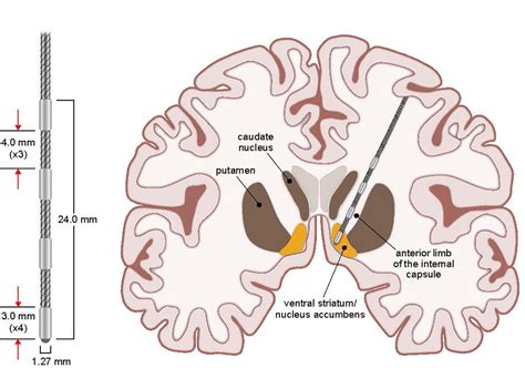 deep brain stimulation provides relief for severe ocd sufferer r interestingasfuck