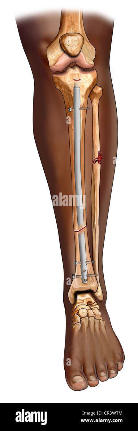 Tibia Nail Hi Res Stock Photography And Images Alamy