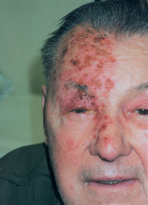 Herpes Zoster Shingles Diseases And Conditions Minuteconsult Free
