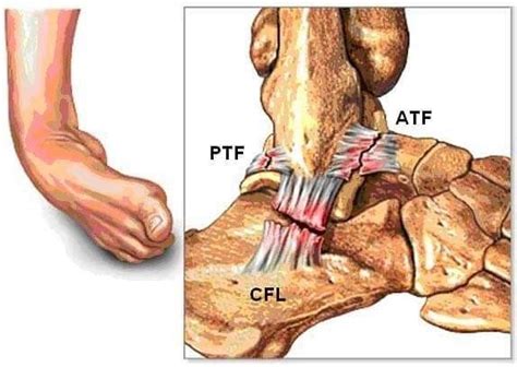 Foods to help heal sprains. Ankle sprain | Esguince de tobillo, Anatomía del tobillo y ...