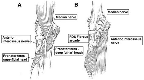 Common Sites Of Compression In Anterior Interosseous Nerve Ain
