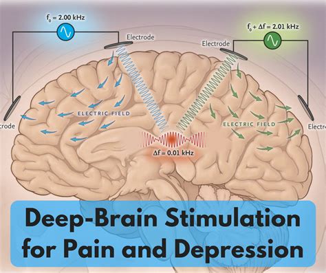Deep Brain Stimulation For Pain And Depression Center For