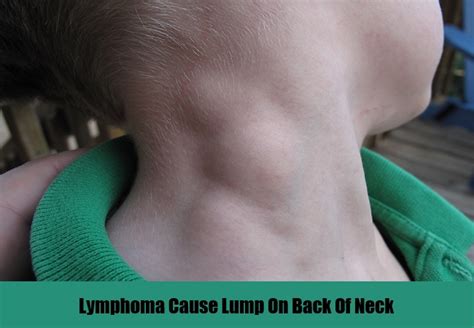 Causes And Symptoms Of Lump On Back Of Neck Natural Home Remedies