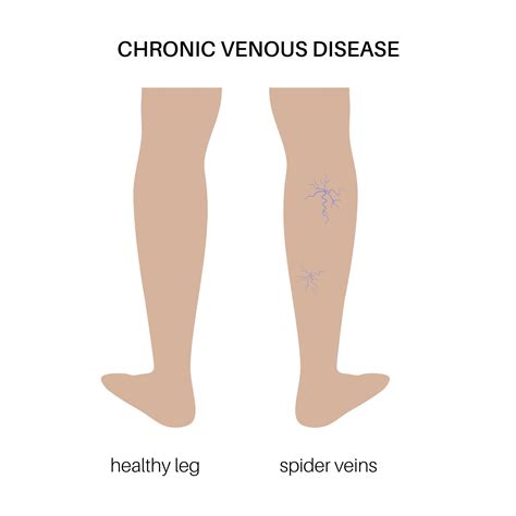 Spider Veins And Varicose Veins The Surgical Clinic