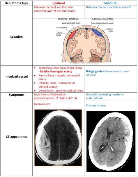 My Notes For Usmle — Epidural And Subdural Hematoma