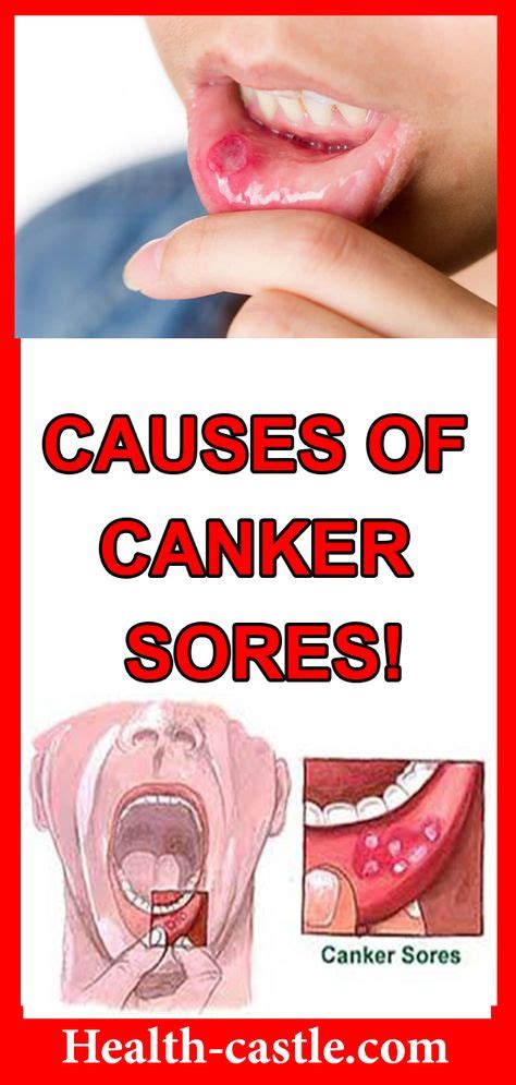 Causes Of Canker Sores Millions Of People Get Canker Sores Every Year