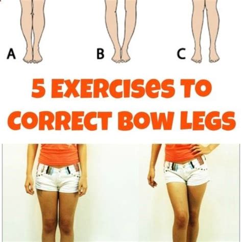 Bow Legs Correction 5 Exercises To Correct Bow Legs Effective Program