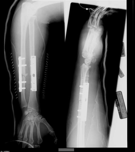 Arm X Ray For Medical Malpractice — Ginzkey Law Office