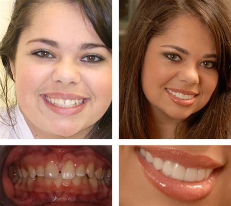 Dental Smile Gallery Real Before And After Photos Mclean Va Dentist