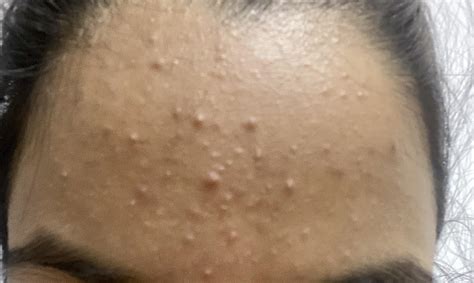 Acne Bad Breakout On My Forehead Since Last Week Need Help What