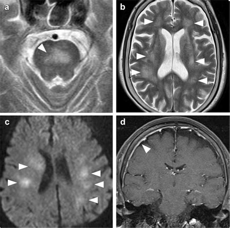 Categorization Of Abnormal Brain Mri Imaging In Patients With Ivlbcl A