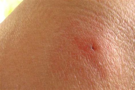 8 Different Types Of Insect Bites Or Stings And How To Treat Them