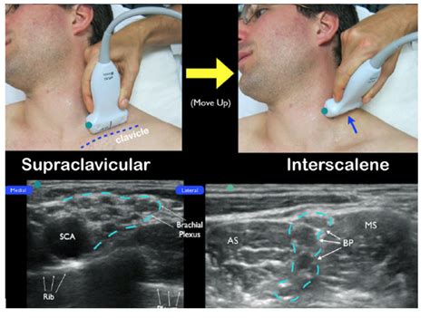 Ultrasound Guided Interscalene Brachial Plexus Nerve Block Laptrinhx News