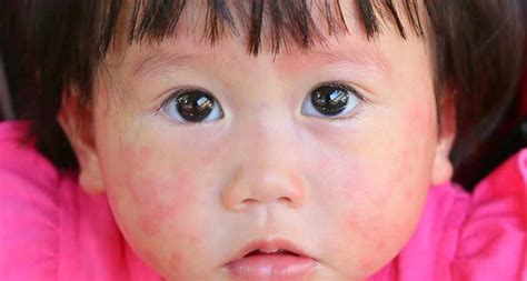 Rash Call Red Bumps In Childhood Can Be Mistakenly Identified As A