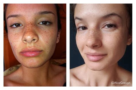 How I Cured My Perioral Dermatitis—the Skin Condition Youve Never