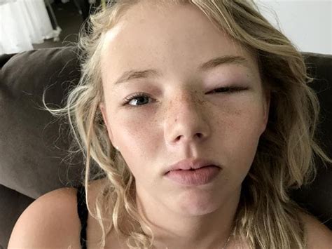 kmart eye mask ‘blinds teen with allergic reaction adelaide now