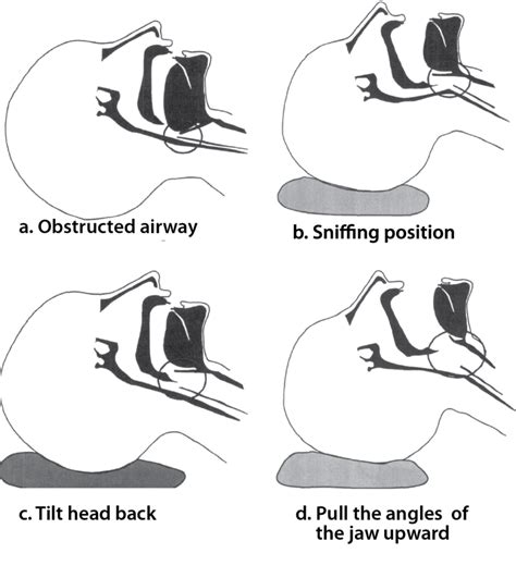 Airway Emergency Start With The Basics Of Airway Management The Airway Jedi