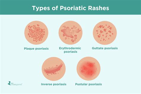 Psoriatic Arthritis Rash Symptoms Treatment And Pictures
