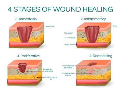 What Are The Stages Of Wound Healing Best Design Idea